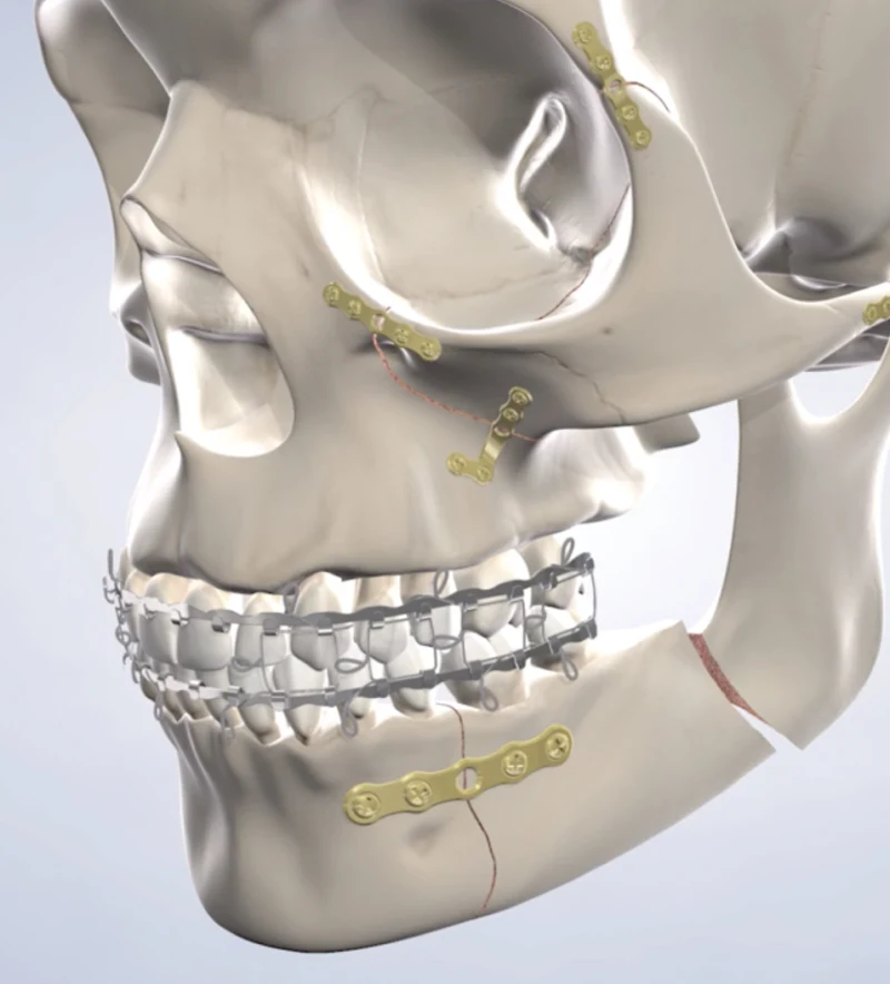facial trauma procedure at Arizona Oral and Maxillofacial Surgery