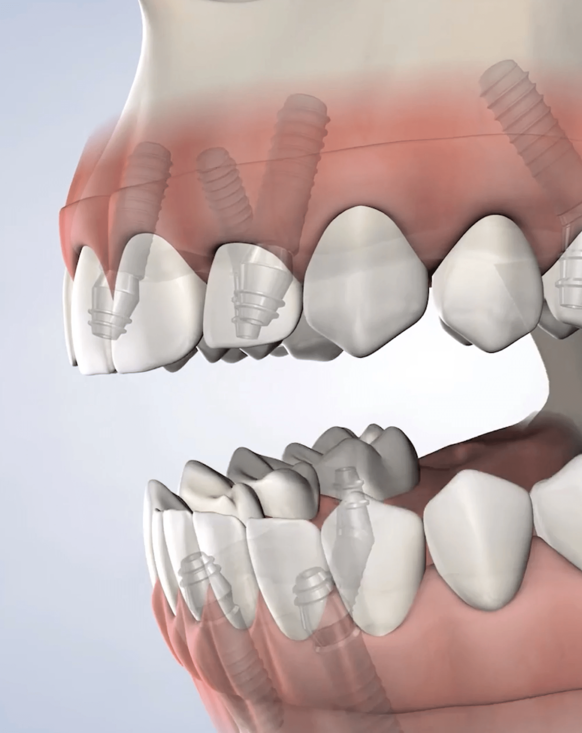 Full-Arch Restoration Procedure at Arizona Oral and Maxillofacial Suergery