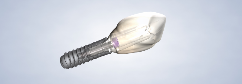 dental implant procedure at Arizona Oral and Maxillofacial Surgery